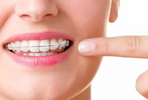 dental braces