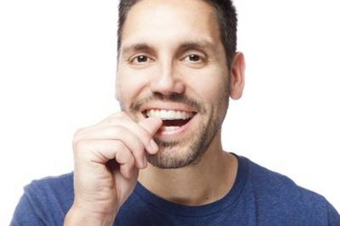 How long do I have to wear my retainers?