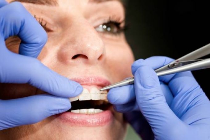 Which Are The Best Braces for Adults?