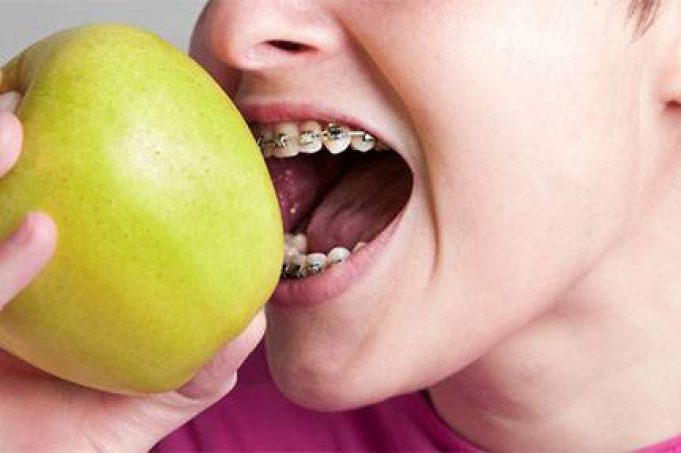 How will braces affect my child’s everyday routine?