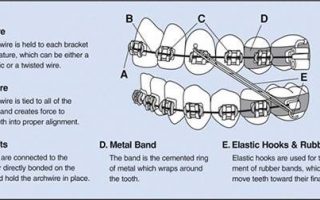 Breaking down the braces lingo