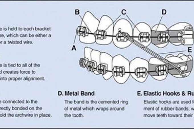 Breaking down the braces lingo