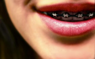 The stages of braces