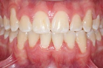 braces for adults