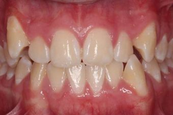 braces for adults