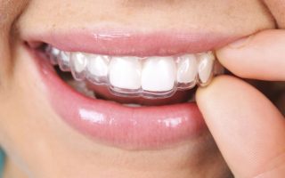 An insight into Invisalign
