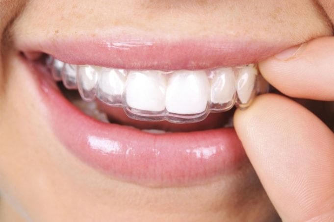 An insight into Invisalign