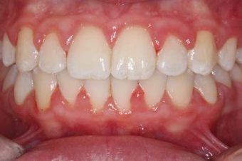 braces for kids