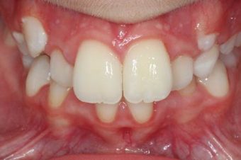 braces for kids