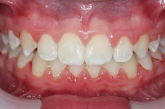 braces for kids