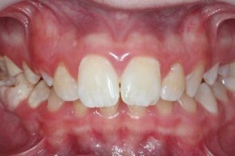 braces for kids