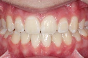 braces for kids