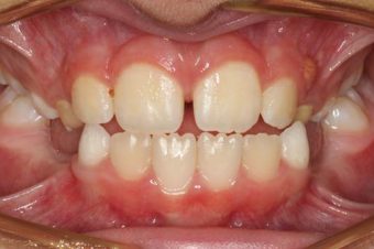braces for kids