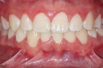 child before braces
