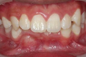child before braces