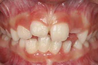 Early Intervention on Orthodontic Issues