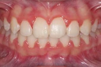 Early Intervention on Orthodontic Issues