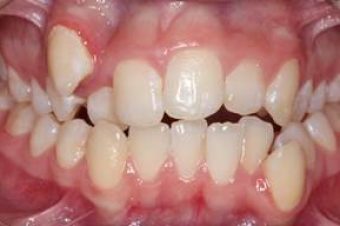 misaligned teeth