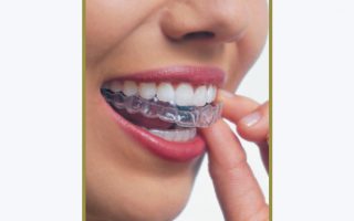 I want braces but I don’t want anyone to know!