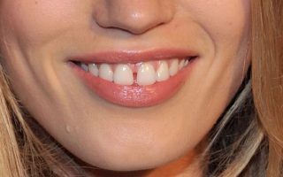 Mind the gap – A diastema