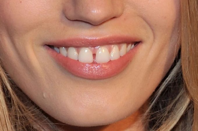 Mind the gap – A diastema