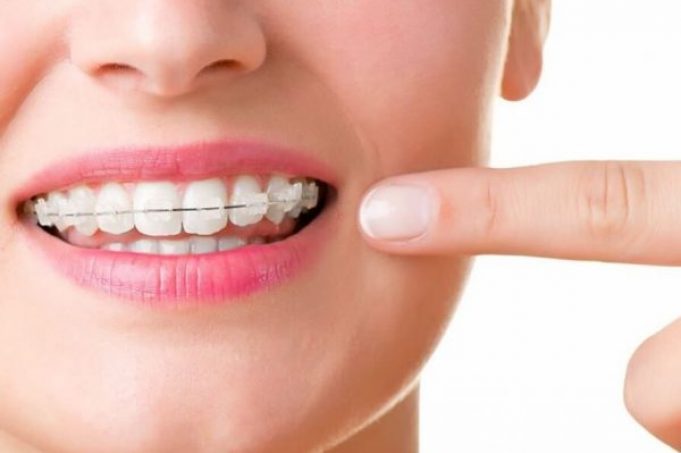 The orthodontic process in six simple steps