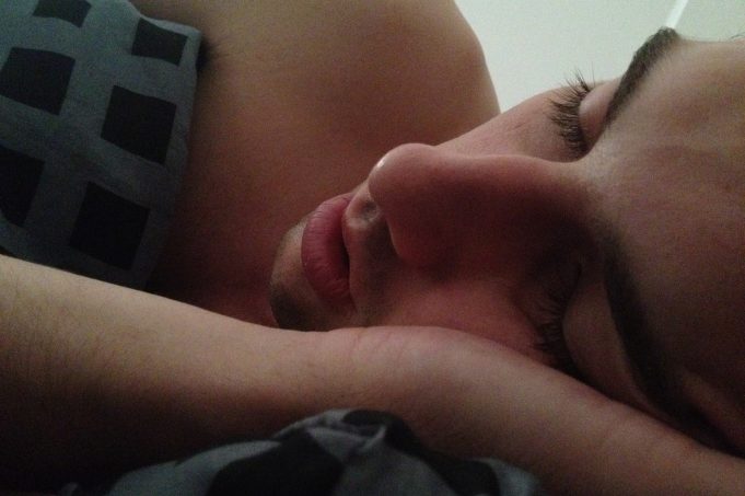 A simple orthodontic solution to sleep apnoea