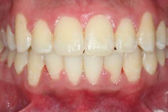 misaligned teeth