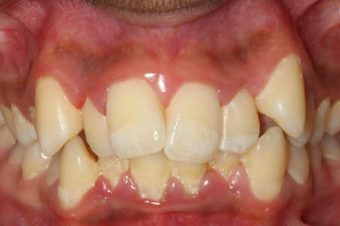misaligned teeth