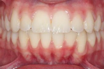 before orthodontics traetment teens