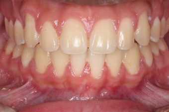 child braces