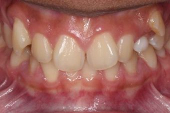 child braces