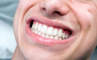Tooth grinding and braces