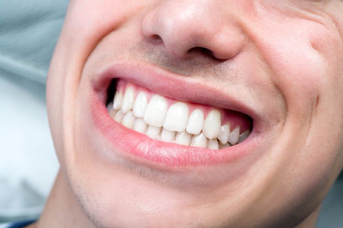 Tooth grinding and braces