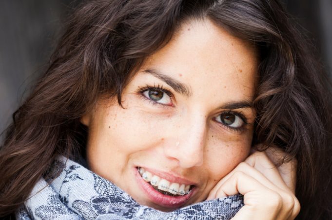 Adult braces – What you need to know