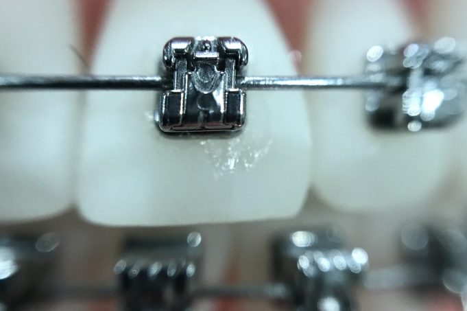 Why we use Damon braces